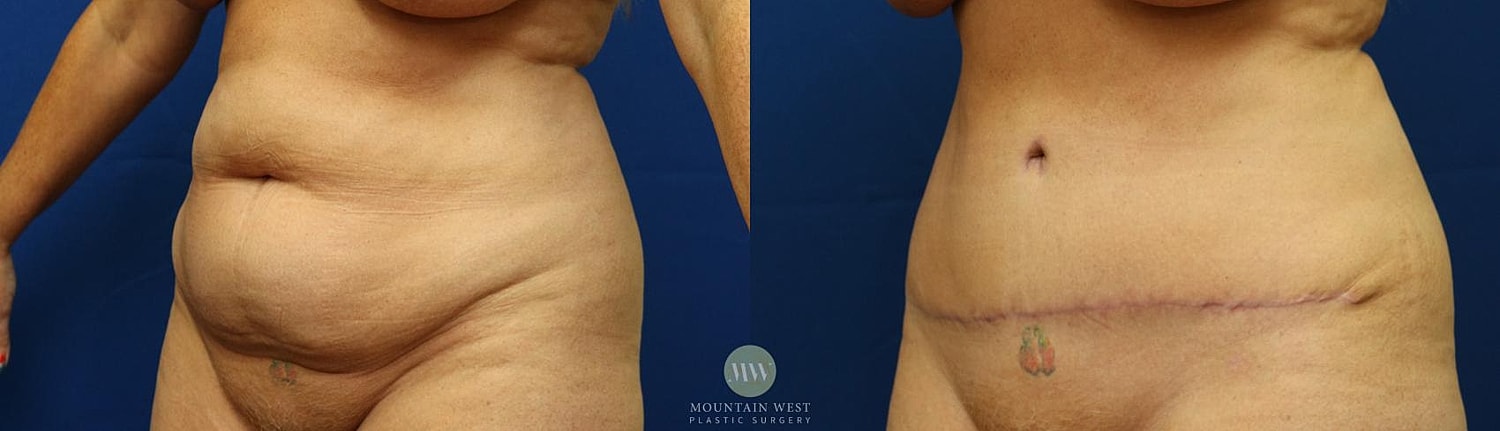 Tummy Tuck Before & After