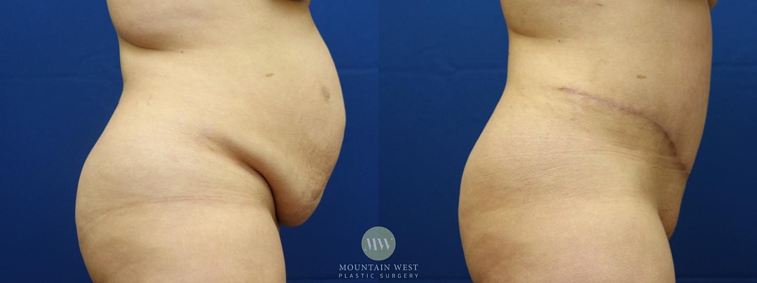 Tummy Tuck Before & After