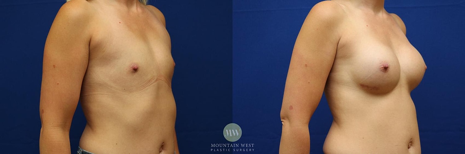 Breast Augmentation Before & After