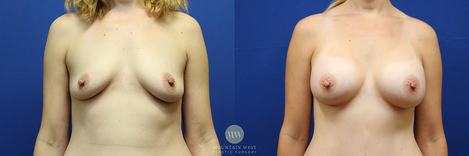 Breast Augmentation Before & After