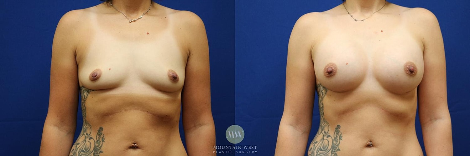 Breast Augmentation Before & After