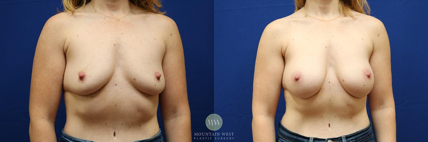Breast Augmentation Before & After