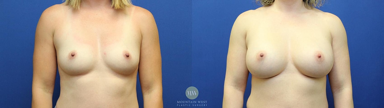 Breast Augmentation Before & After