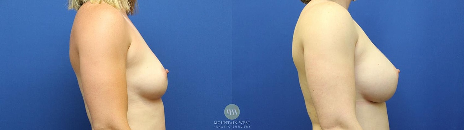 Breast Augmentation Before & After