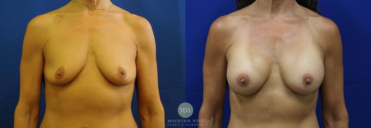 Breast Augmentation Before & After