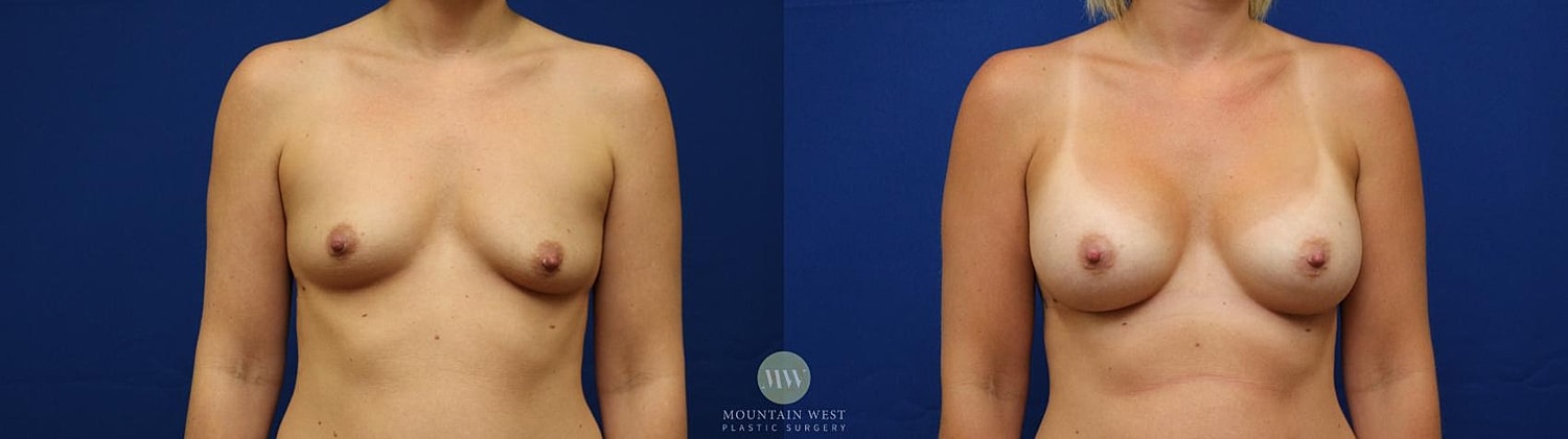 Breast Augmentation Before & After