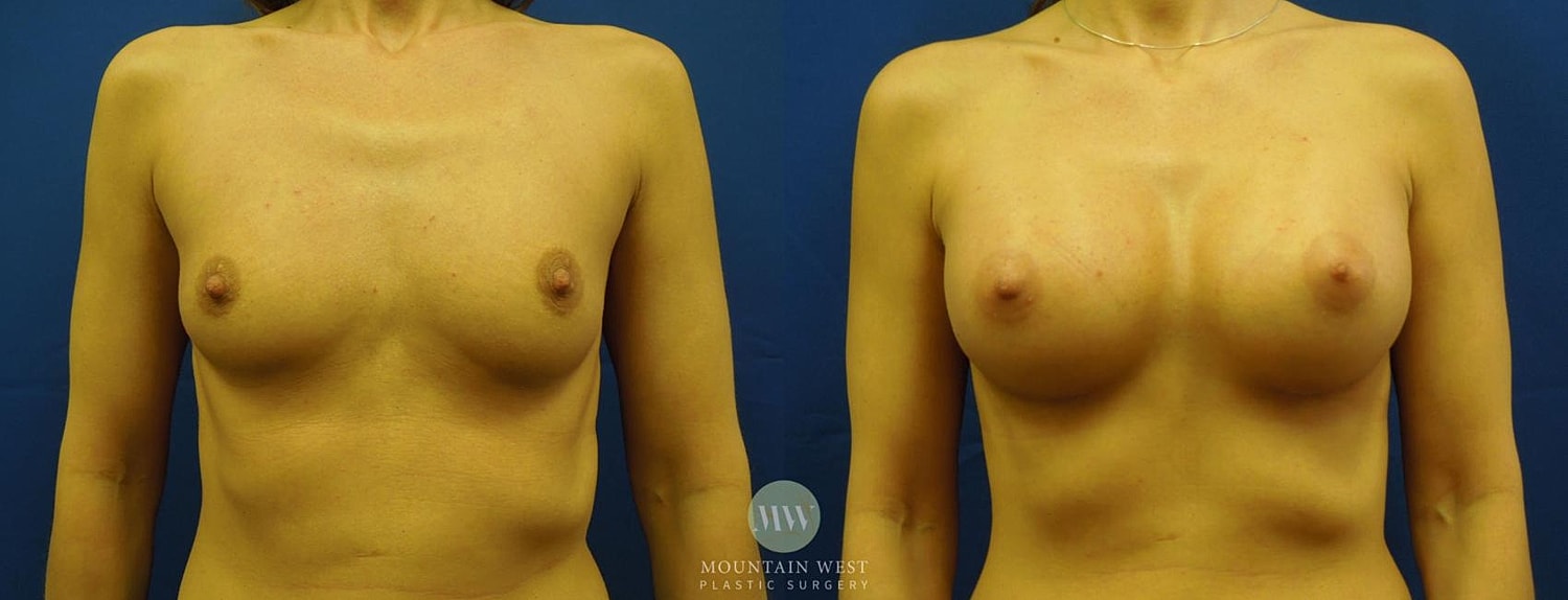 Breast Augmentation Before & After