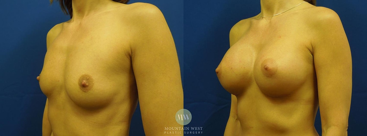Breast Augmentation Before & After