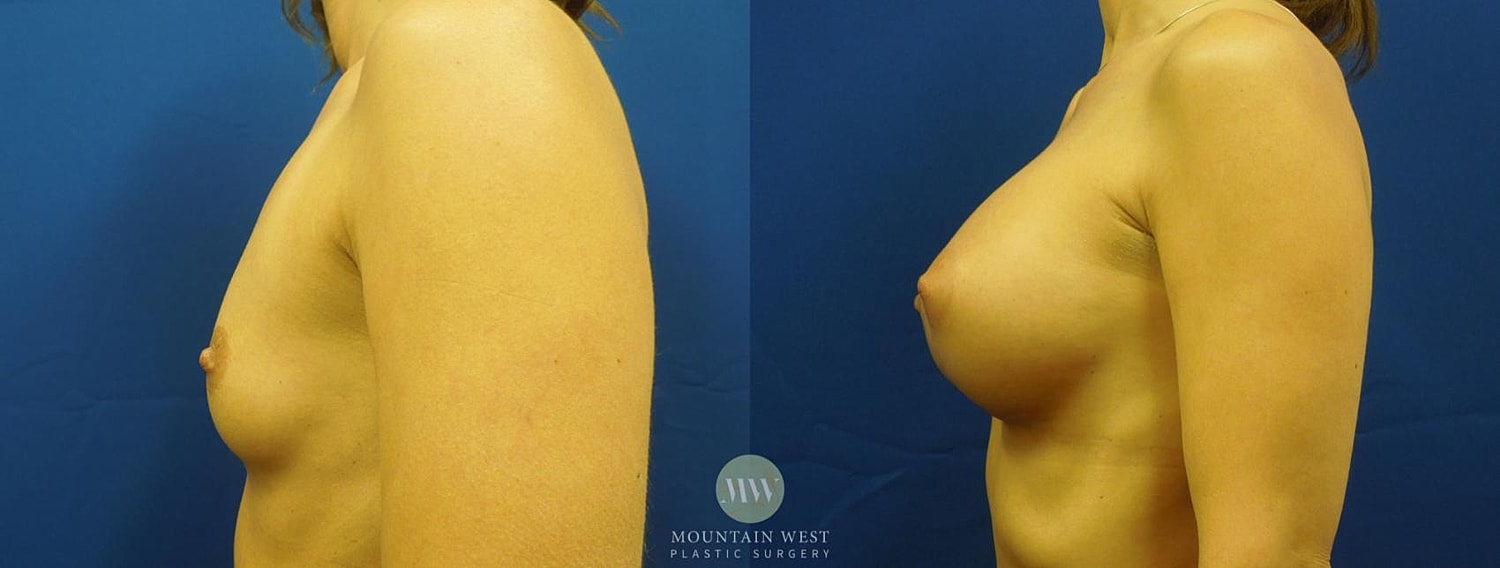 Breast Augmentation Before & After