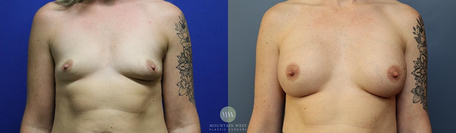 Breast Augmentation Before & After