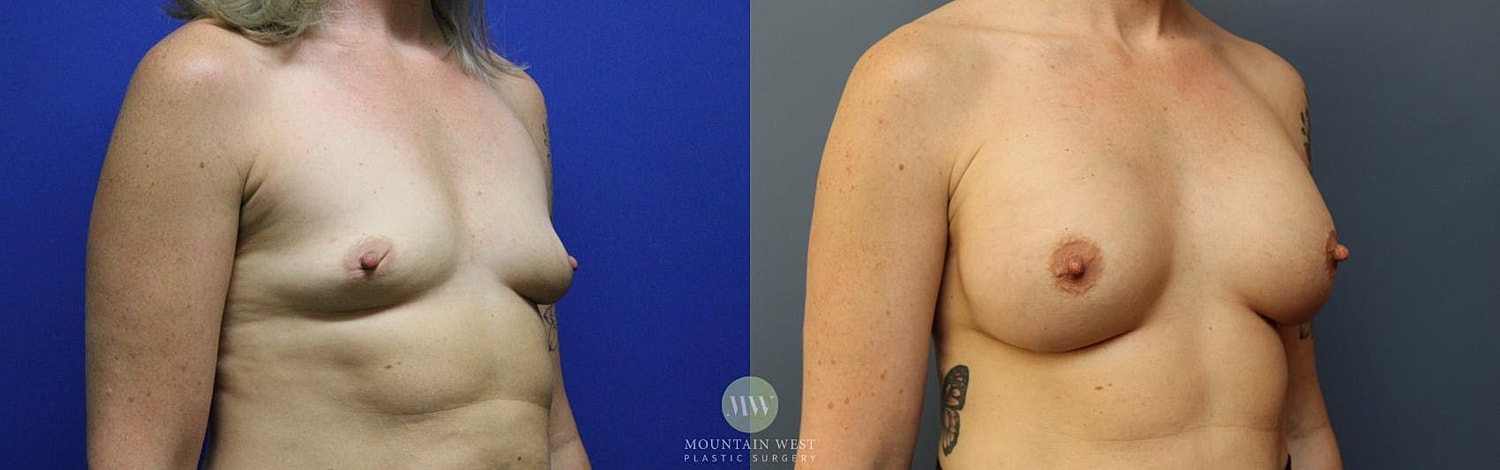 Breast Augmentation Before & After