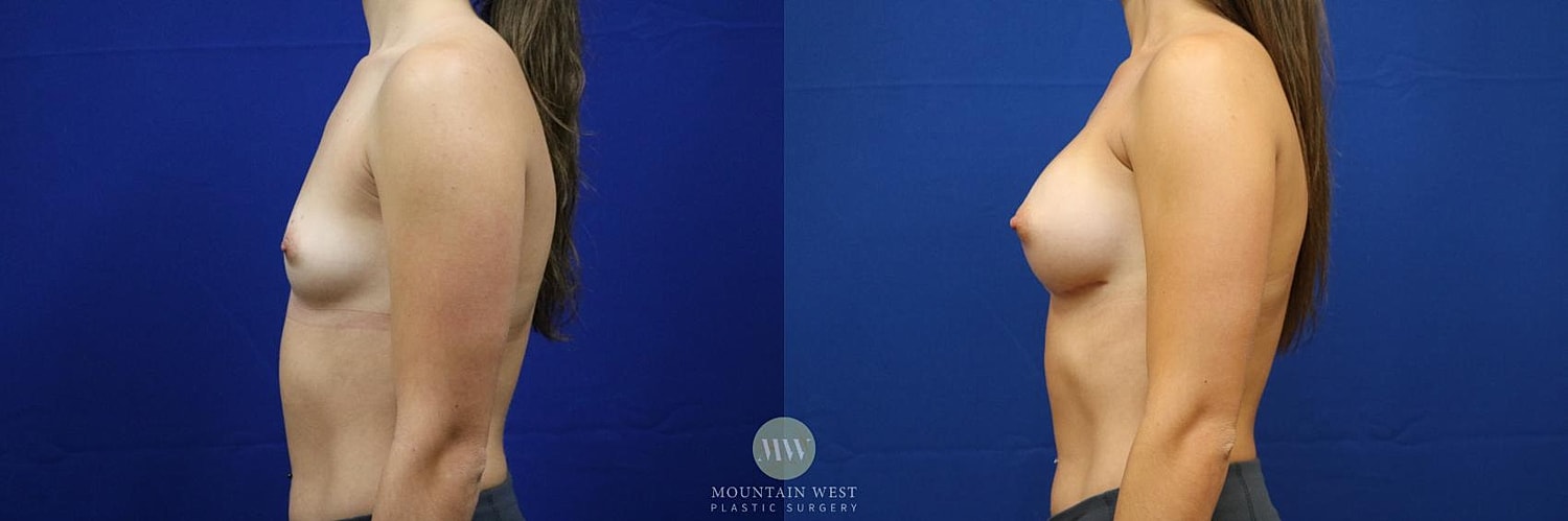 Breast Augmentation Before & After