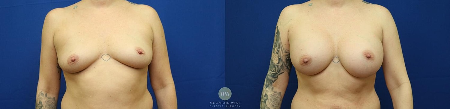 Breast Augmentation Before & After
