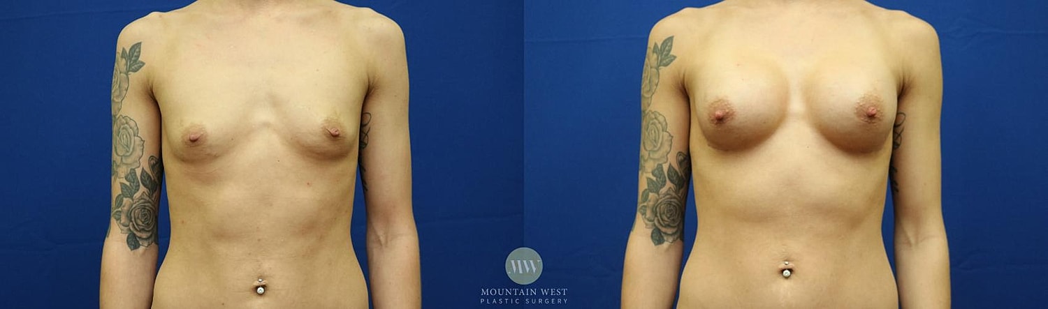Breast Augmentation Before & After