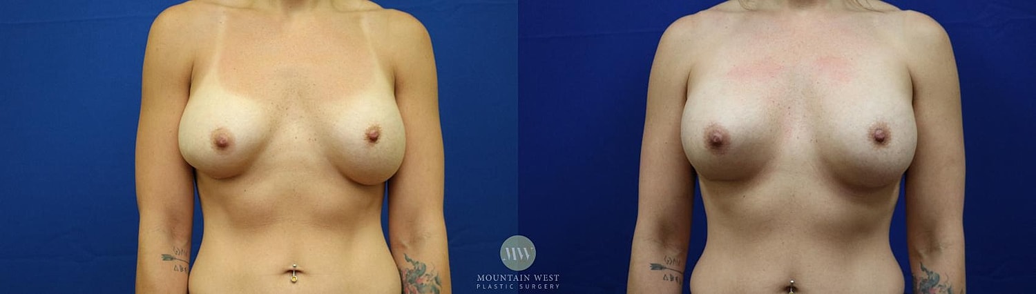 Breast Augmentation Before & After