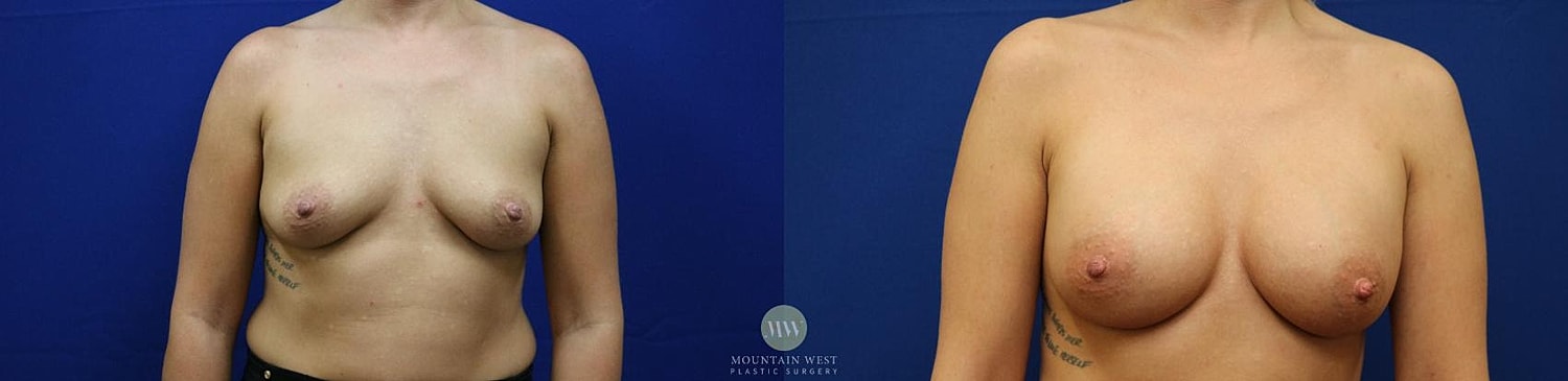 Breast Augmentation Before & After