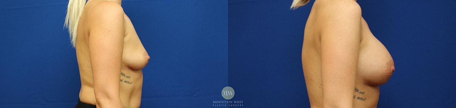 Breast Augmentation Before & After