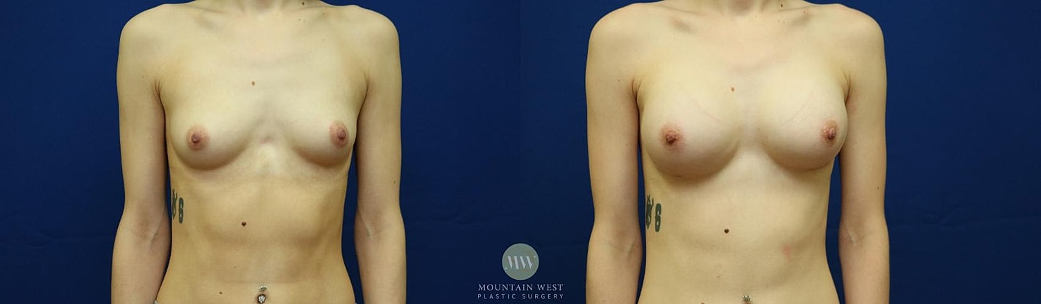 Breast Augmentation Before & After
