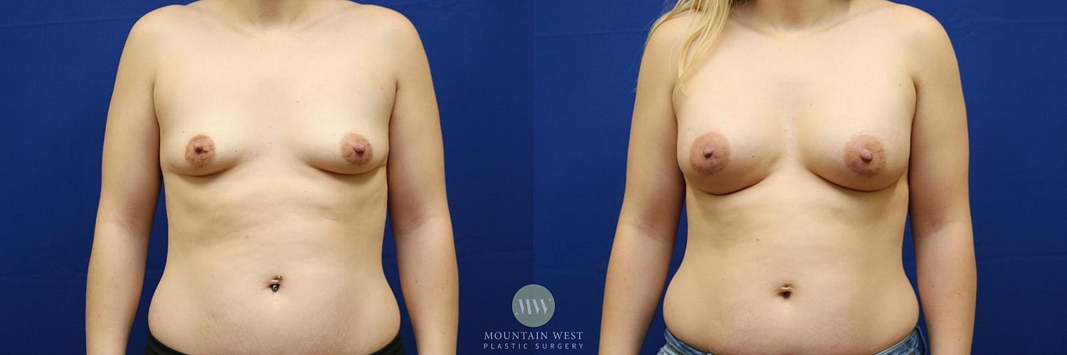 Breast Augmentation Before & After