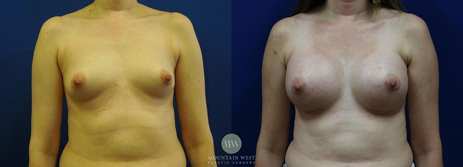 Breast Augmentation Before & After