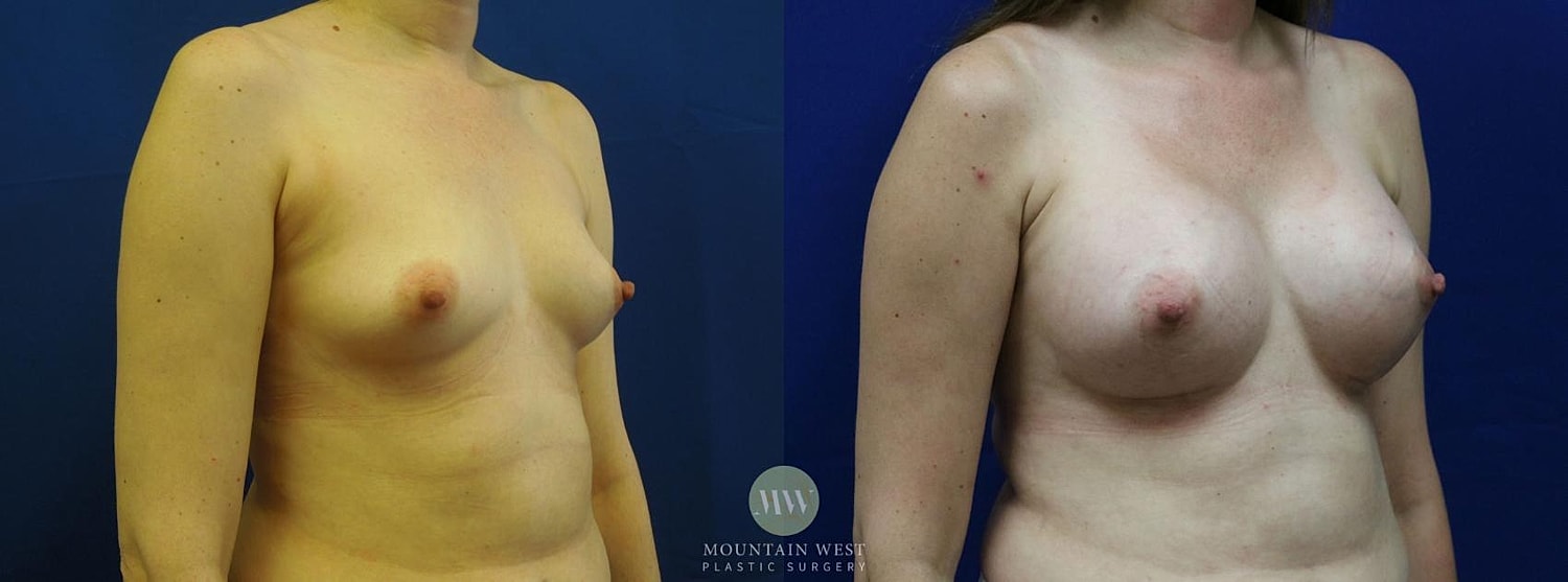Breast Augmentation Before & After