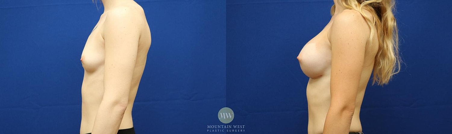 Breast Augmentation Before & After