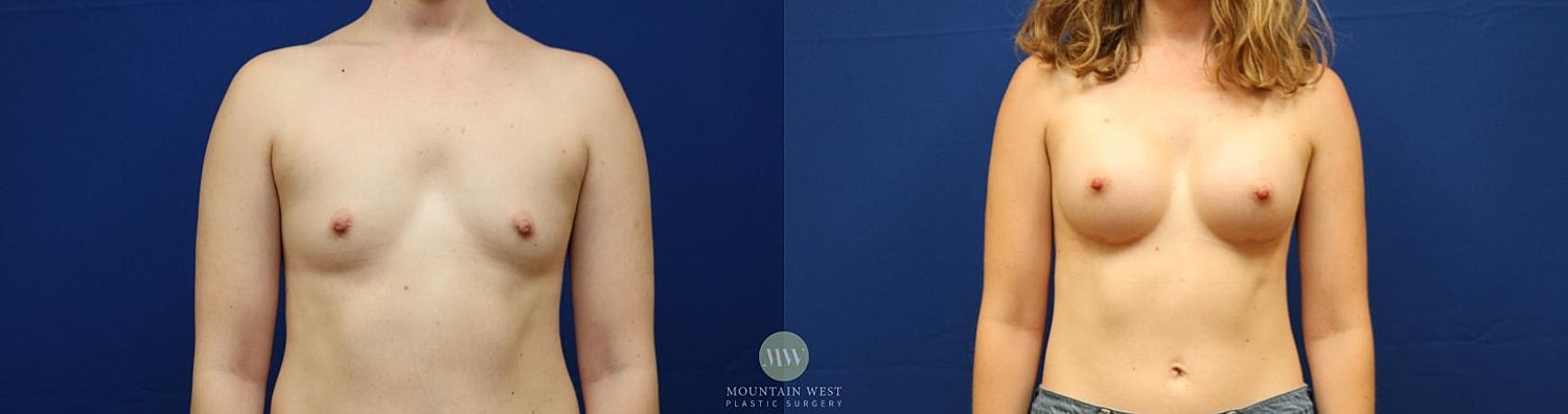 Breast Augmentation Before & After