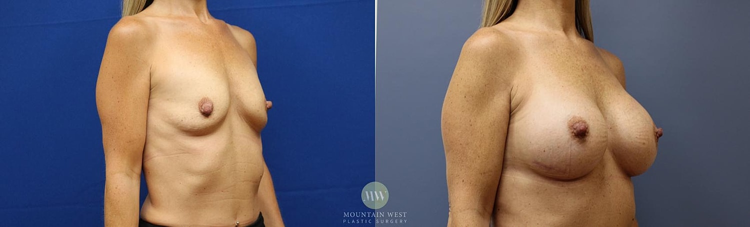 Breast Augmentation Before & After