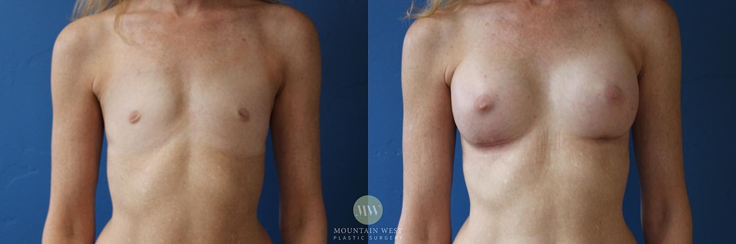 Breast Augmentation Before & After