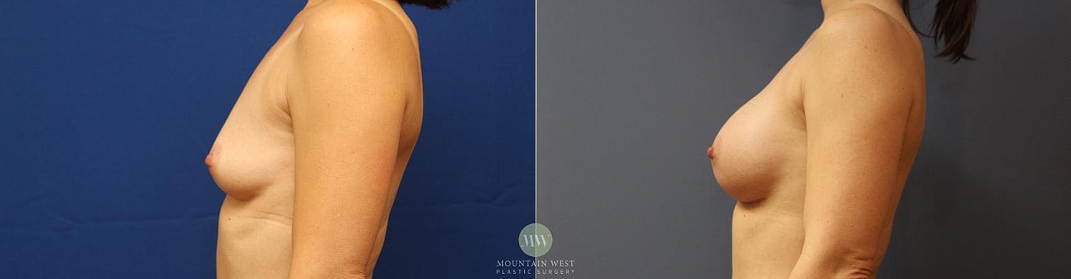 Breast Augmentation Before & After