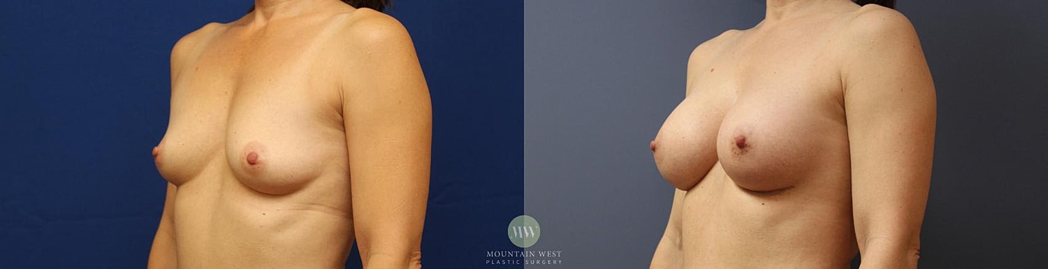 Breast Augmentation Before & After