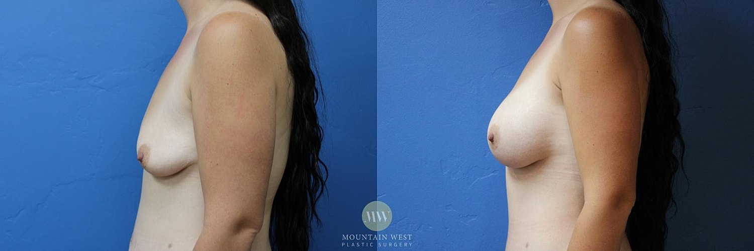 Breast Augmentation Before & After