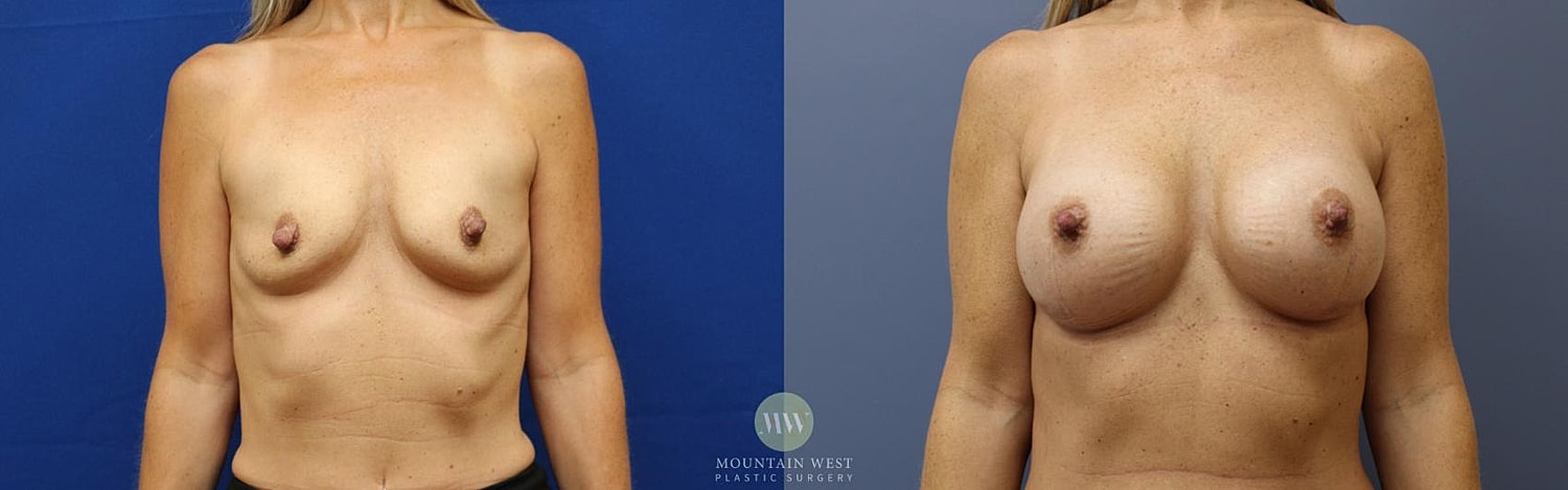 Breast Augmentation Before & After