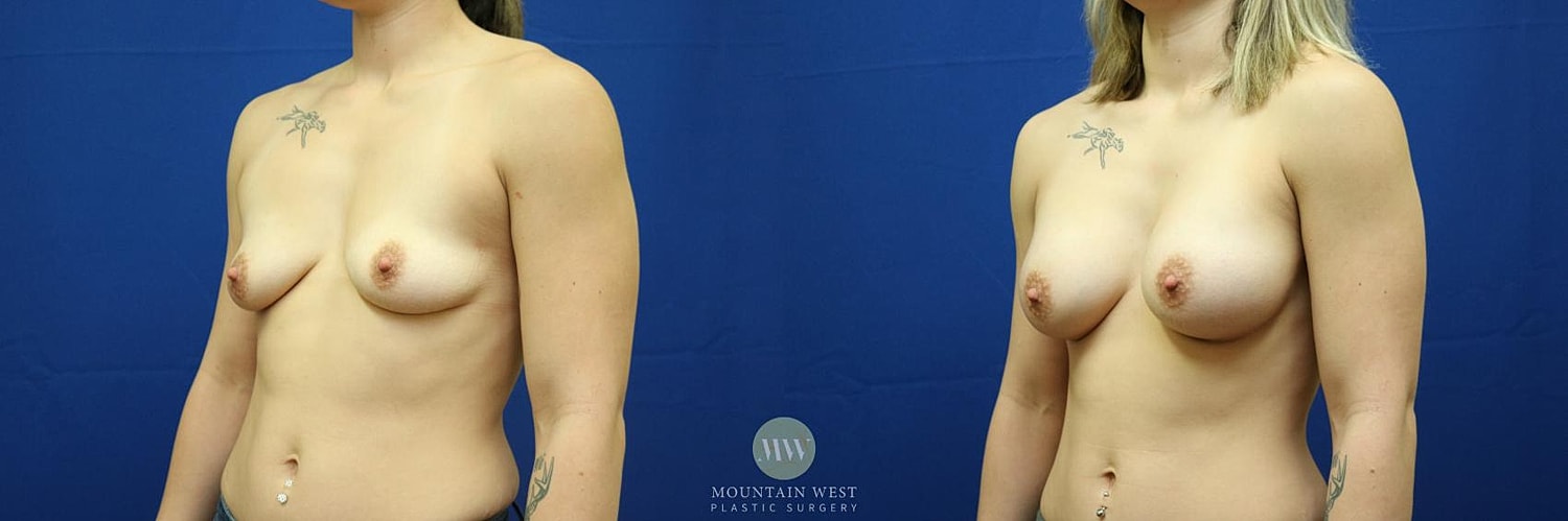 Breast Augmentation Before & After