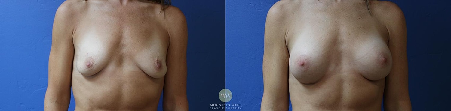 Breast Augmentation Before & After