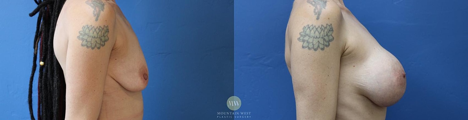 Breast Augmentation Before & After