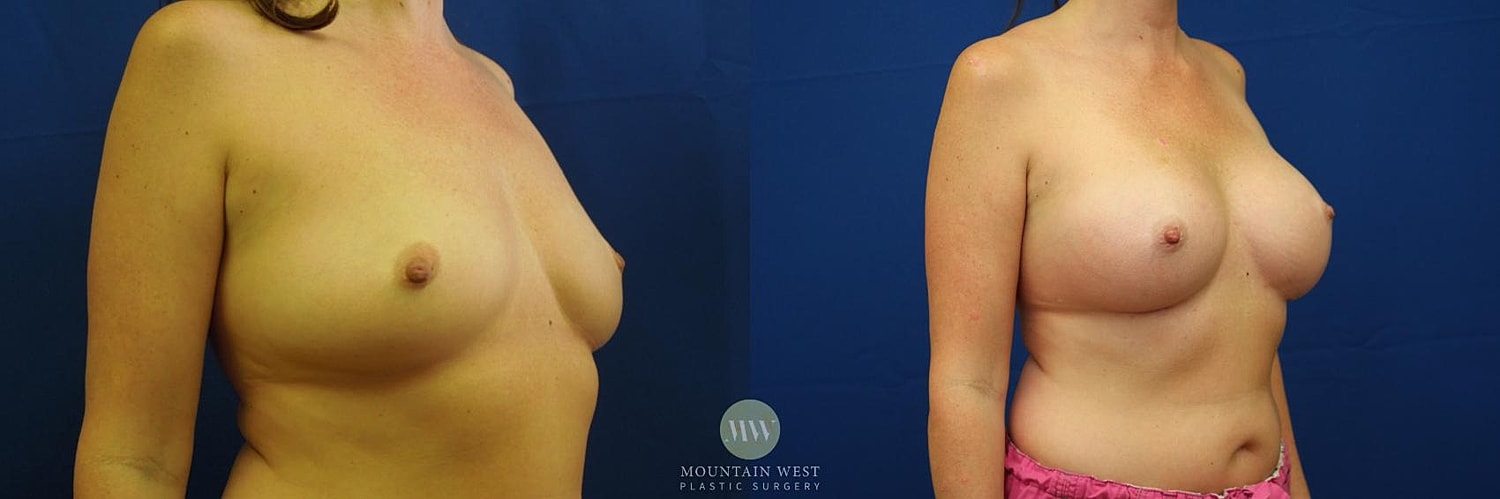 Breast Augmentation Before & After