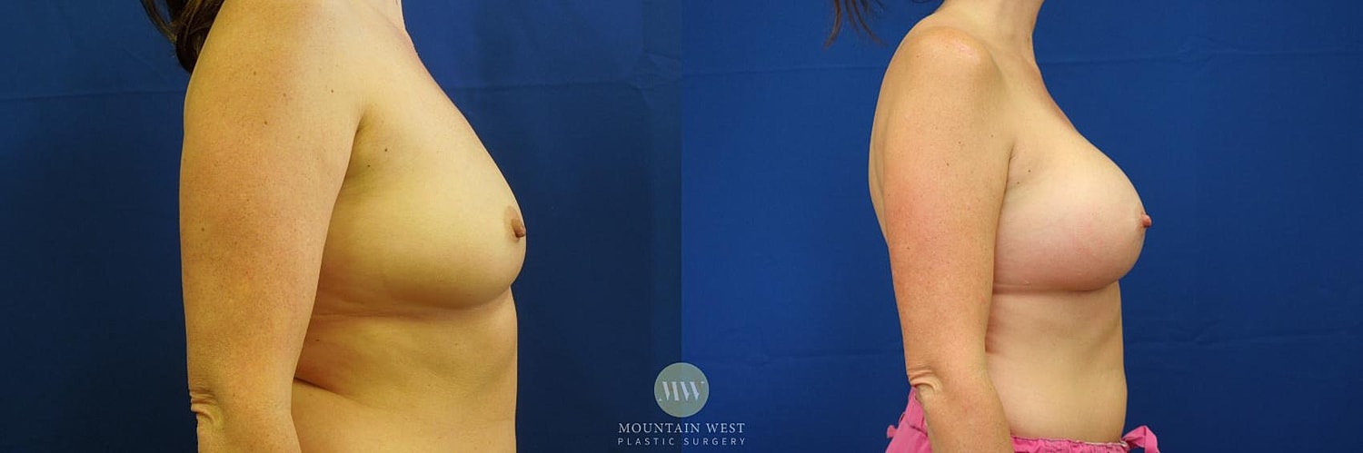 Breast Augmentation Before & After