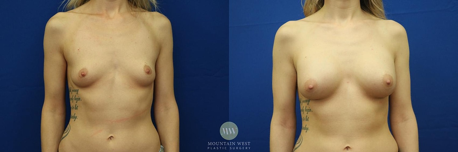 Breast Augmentation Before & After