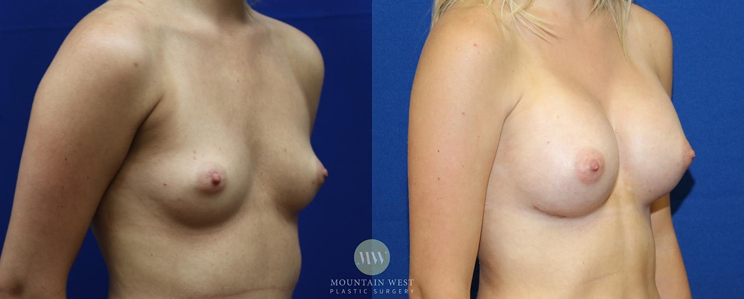 Breast Augmentation Before & After