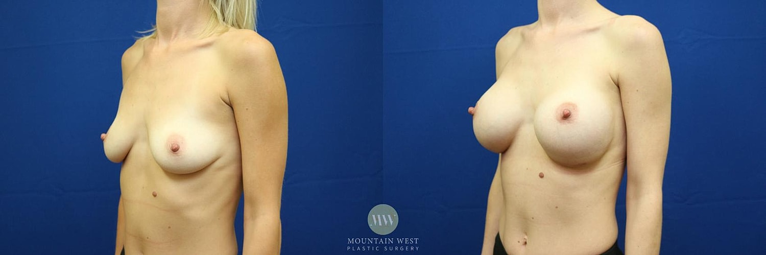 Breast Augmentation Before & After