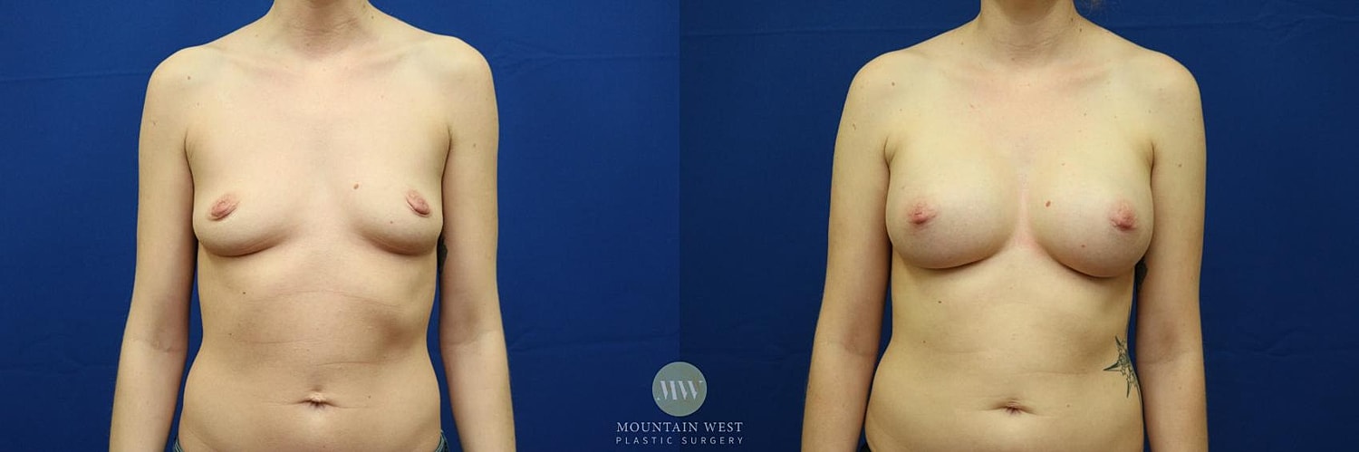 Breast Augmentation Before & After