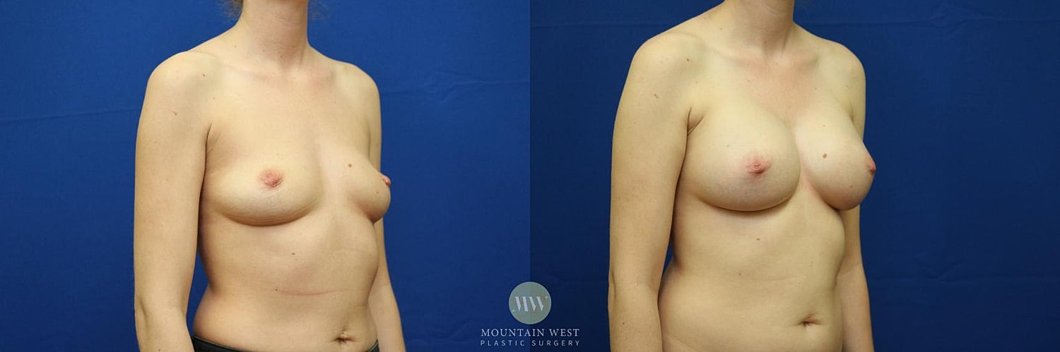 Breast Augmentation Before & After