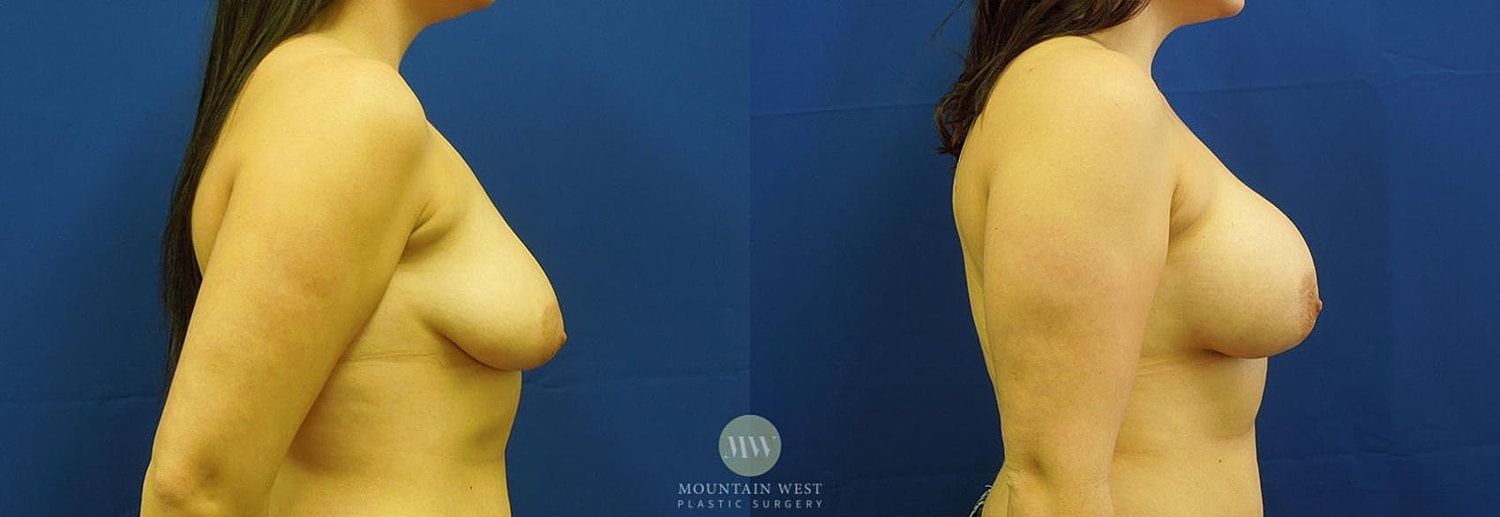 Breast Augmentation Before & After