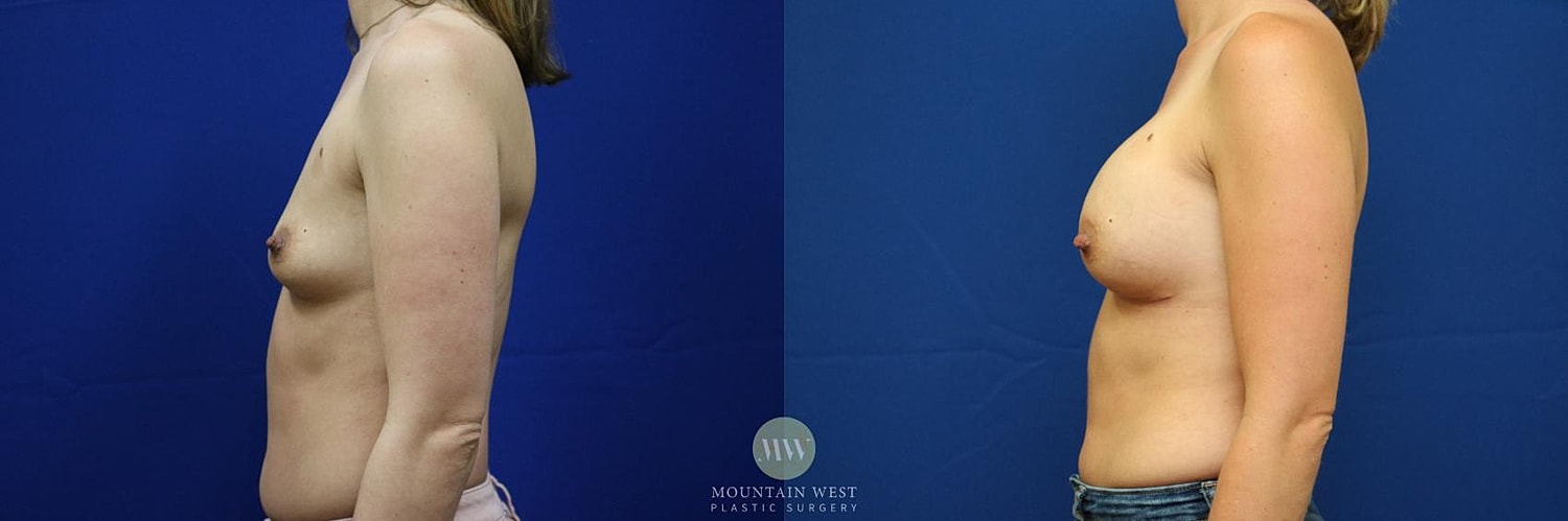 Breast Augmentation Before & After