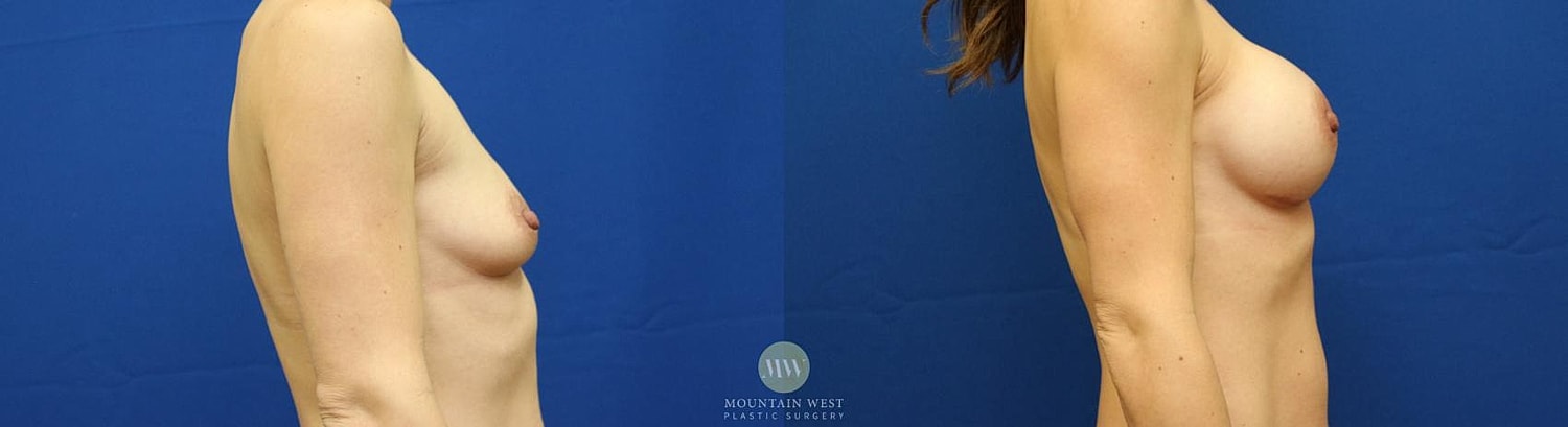 Breast Augmentation Before & After