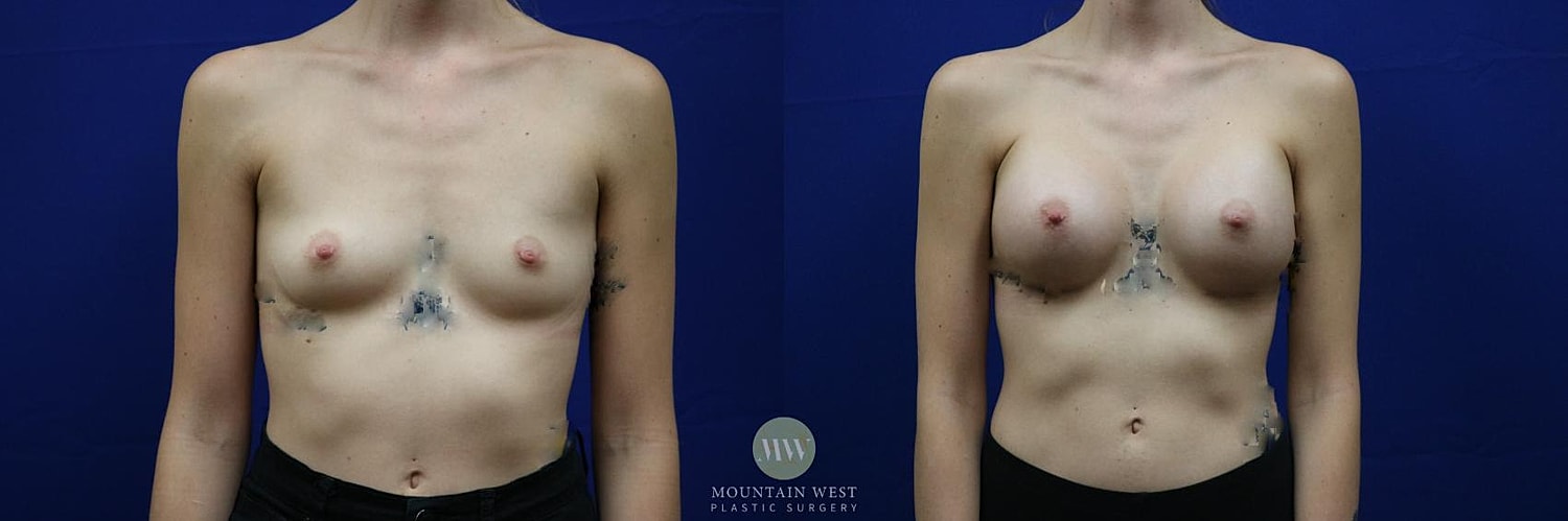 Breast Augmentation Before & After