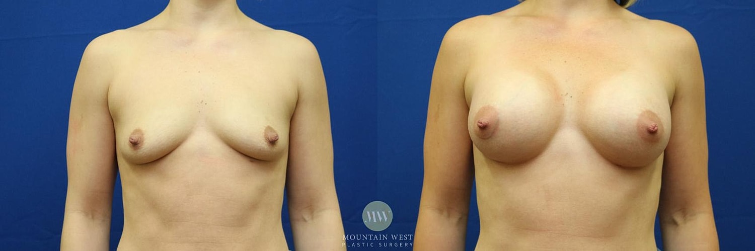 Breast Augmentation Before & After