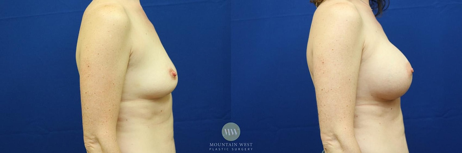 Breast Augmentation Before & After