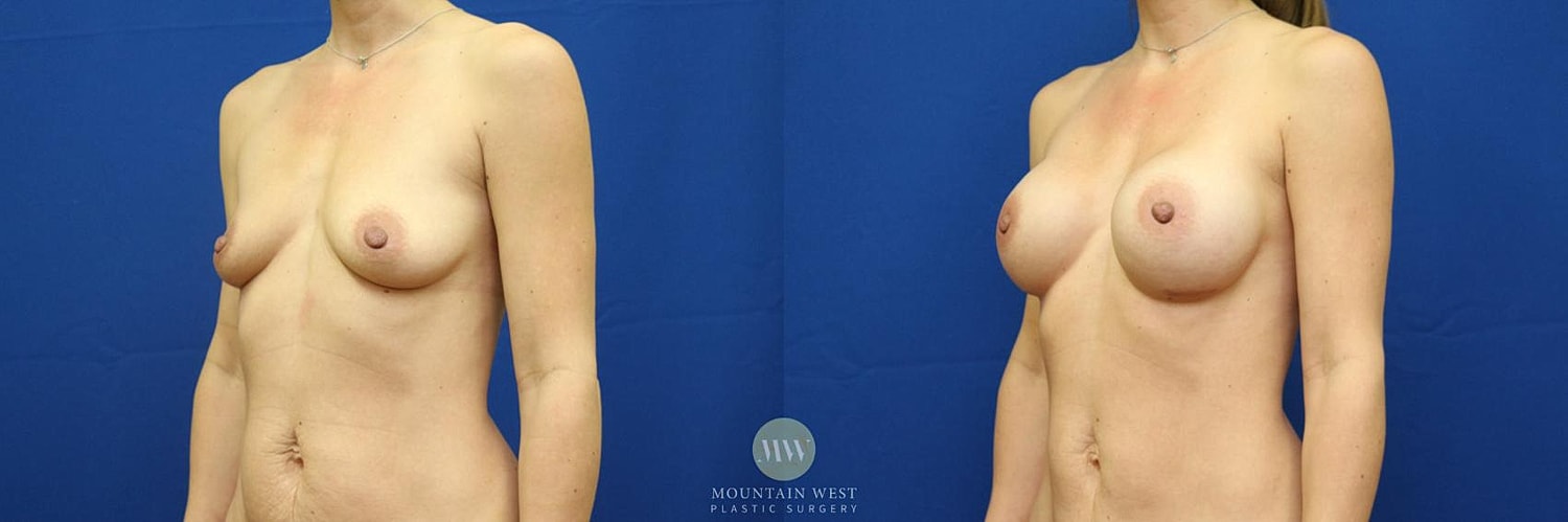 Breast Augmentation Before & After